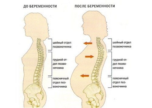 Влияние беременности на состояние спины и позвоночника