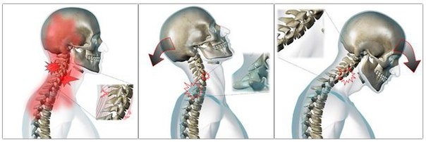Причины и лечение боли в голове и тремора при шейном остеохондрозе