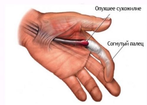 Синдром щелкающего пальца