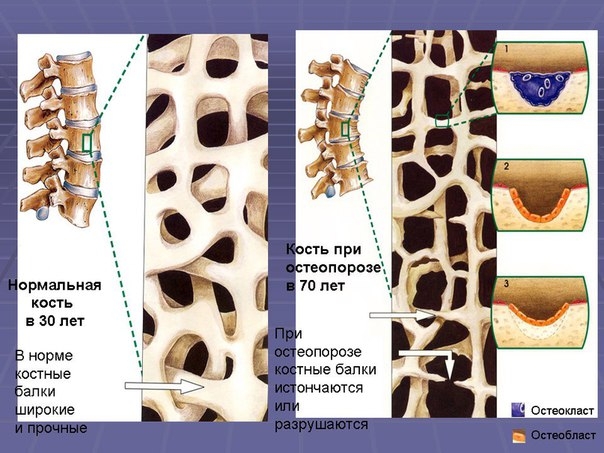 Изучение и лечение остеопороза