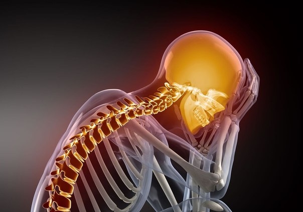 Цервикокраниалгия и шейный остеохондроз: причины, симптомы, методы лечения