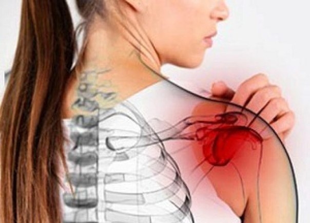 Остеохондроз плеча и лопатки: симптомы и лечение