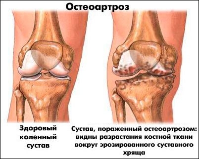 Какие препараты используют для лечения артроза коленного сустава?