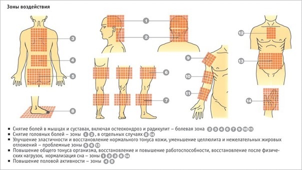 Иглоукалывание при остеохондрозе