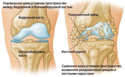 Диета для суставов.