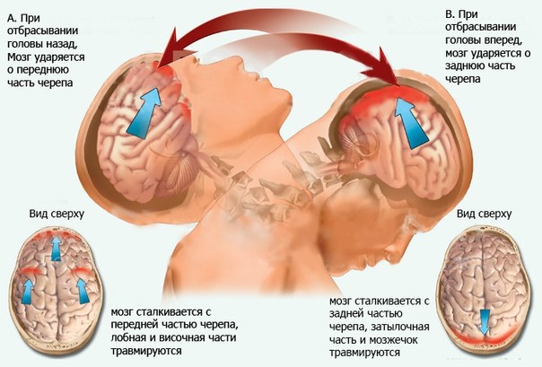 Травмы шеи, шейно-лопаточный синдром