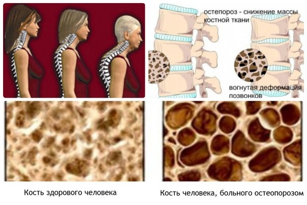 Остеопороз делает женщин хрупкими