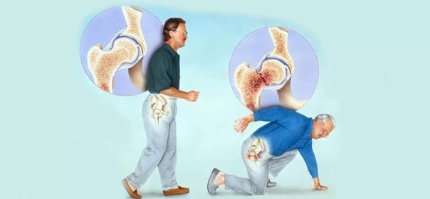 Переломы из-за остеопороза опаснее для мужчин