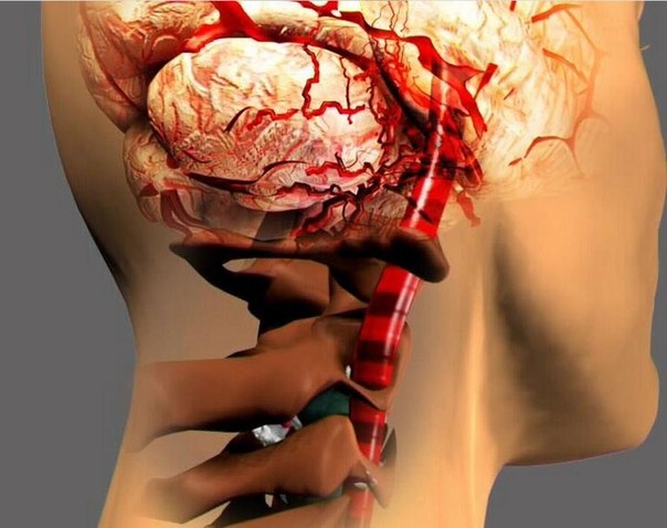 Экстравазальная компрессия позвоночных артерий: симптомы, проявления, диагностика, терапия