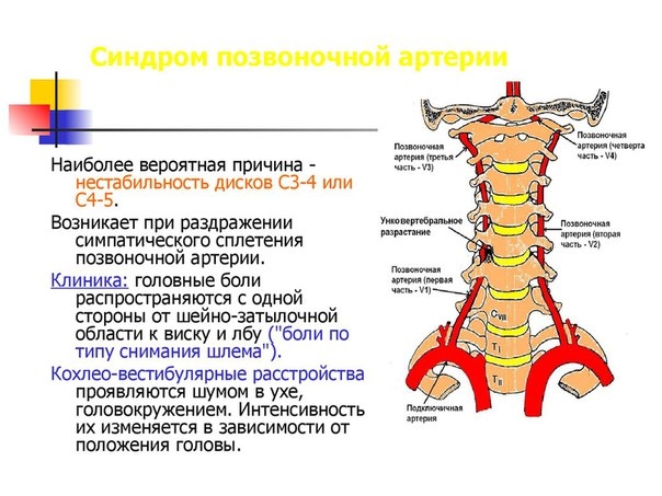 Схема лечения шейного остеохондроза в стадии обострения