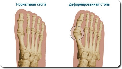 Почему растет «косточка» большого пальца ноги и как распознать заболевание на ранних стадиях