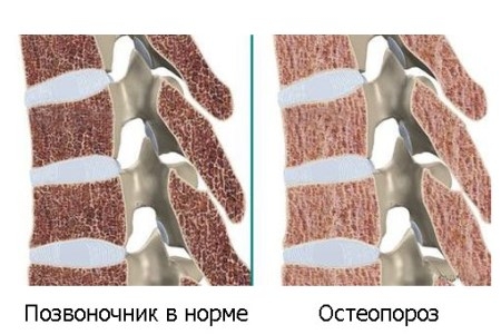 Симптомы и лечение остеопороза шейного и пояснично-крестцового отделов позвоночника