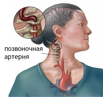Шейный остеохондроз - синдром сдавливания артерии