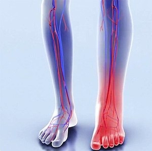 причины онемения ноги