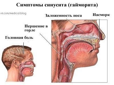 ГОТОВИМ МАЗЬ ДЛЯ ЛЕЧЕНИЕ ГАЙМОРИТА ГОТОВИМ МАЗЬ ДЛЯ ЛЕЧЕНИЕ ГАЙМОРИТА