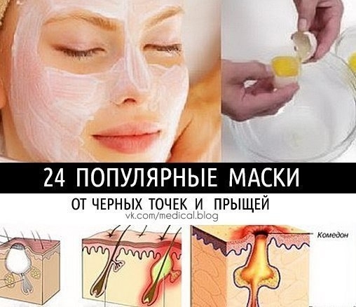 24 ПОПУЛЯРНЫЕ МАСКИ ОТ ЧЕРНЫХ ТОЧЕК И ПРЫЩЕЙ!