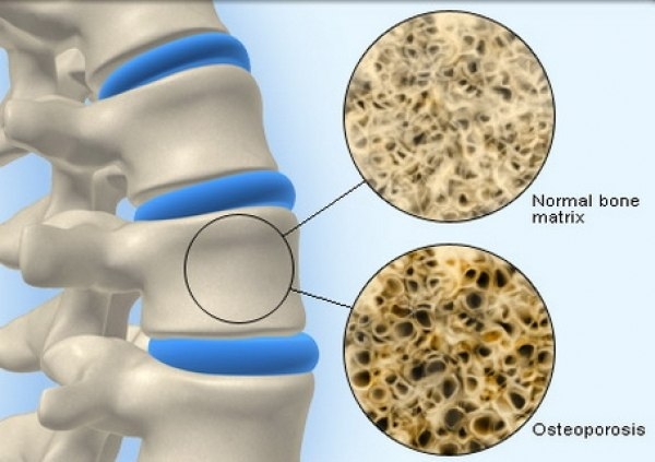 Остеопороз и болезненные ощущения в суставах ног - одна из ведущих причин физической неспособности и малоподвижности среди пожилых людей. В то время как боли в суставах главным образом затрагивают группу старше 45 лет, остеопороз может развиться в любом в