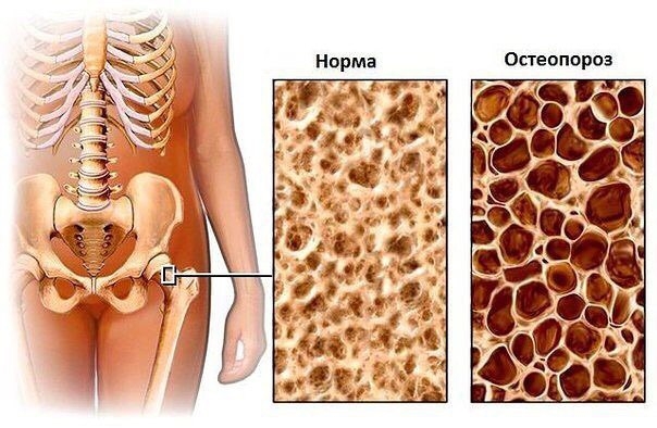 Профилактика остеопороза.