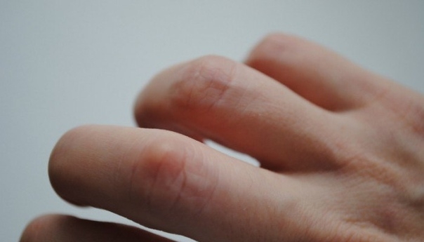 Шишки на суставах пальцев рук: лечение