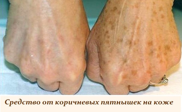 СРЕДСТВО ОТ КОРИЧНЕВЫХ ПЯТНЫШЕК НА КОЖЕ СРЕДСТВО ОТ КОРИЧНЕВЫХ ПЯТНЫШЕК НА КОЖЕ
