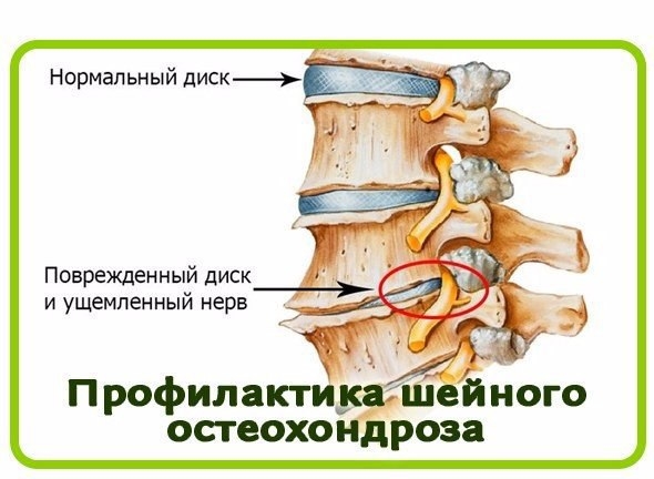 РЕЦЕПТ ОТ ОСТЕОХОНДРОЗА РЕЦЕПТ ОТ ОСТЕОХОНДРОЗА