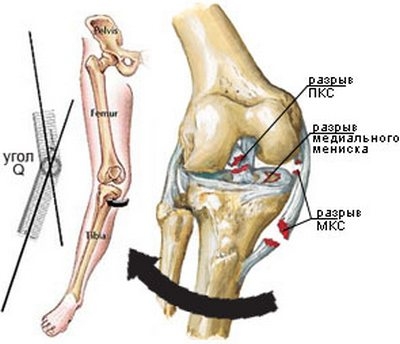 Боль в колене это результат несбалансированной работы мышц.