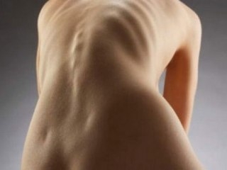 Как лечить кифосколиоз грудного отдела позвоночника?