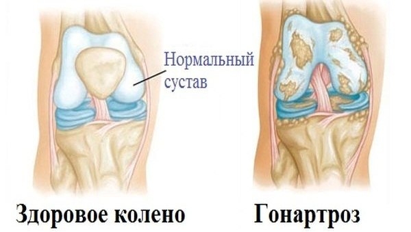 Лечение гонартроза коленного сустава