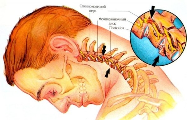 Неспецифический симптом шейного остеохондроза — ком в горле
