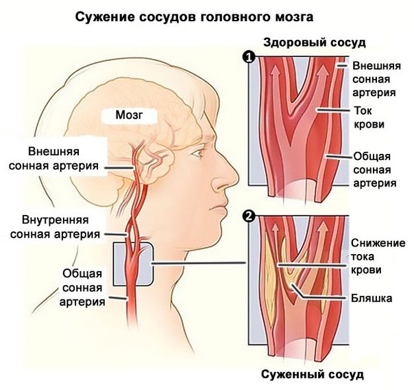 Причины, симптомы и лечение шейной мигрени